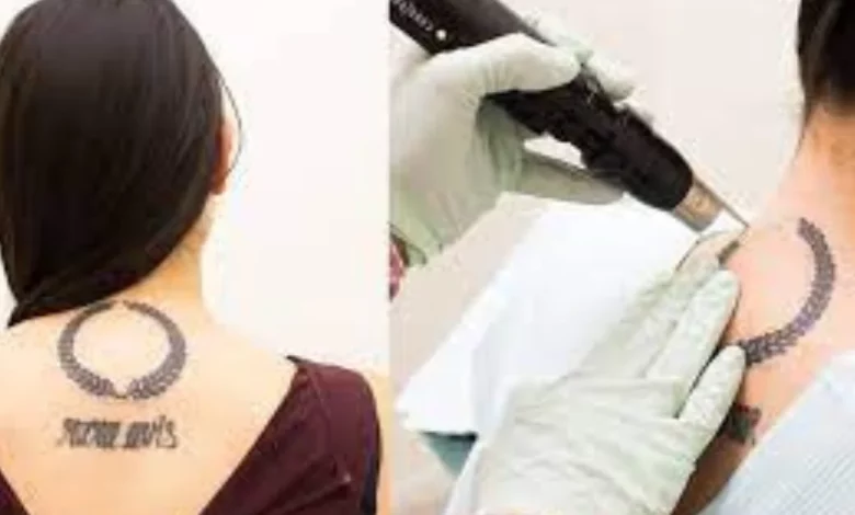 tattoo removal painful