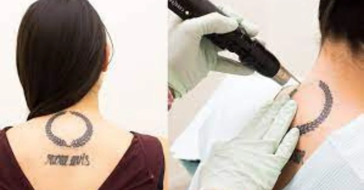 tattoo removal painful