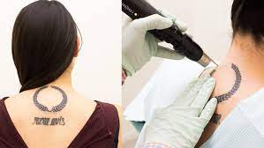 tattoo removal painful