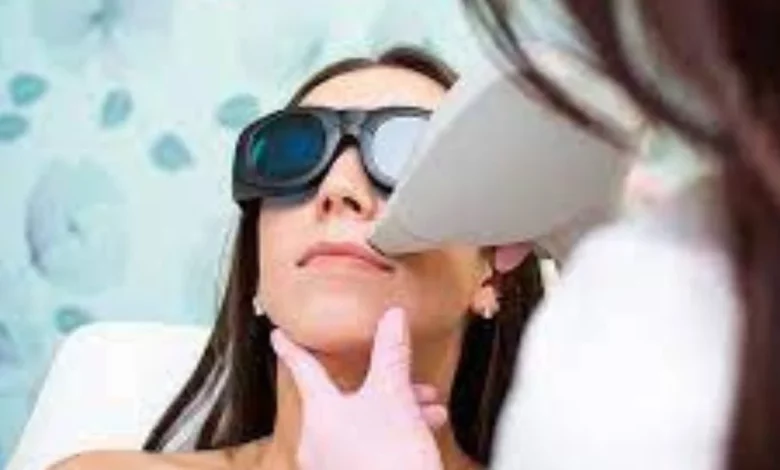 Laser hair removal