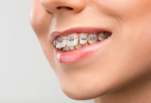 The different kind of orthodontics you can benefit from